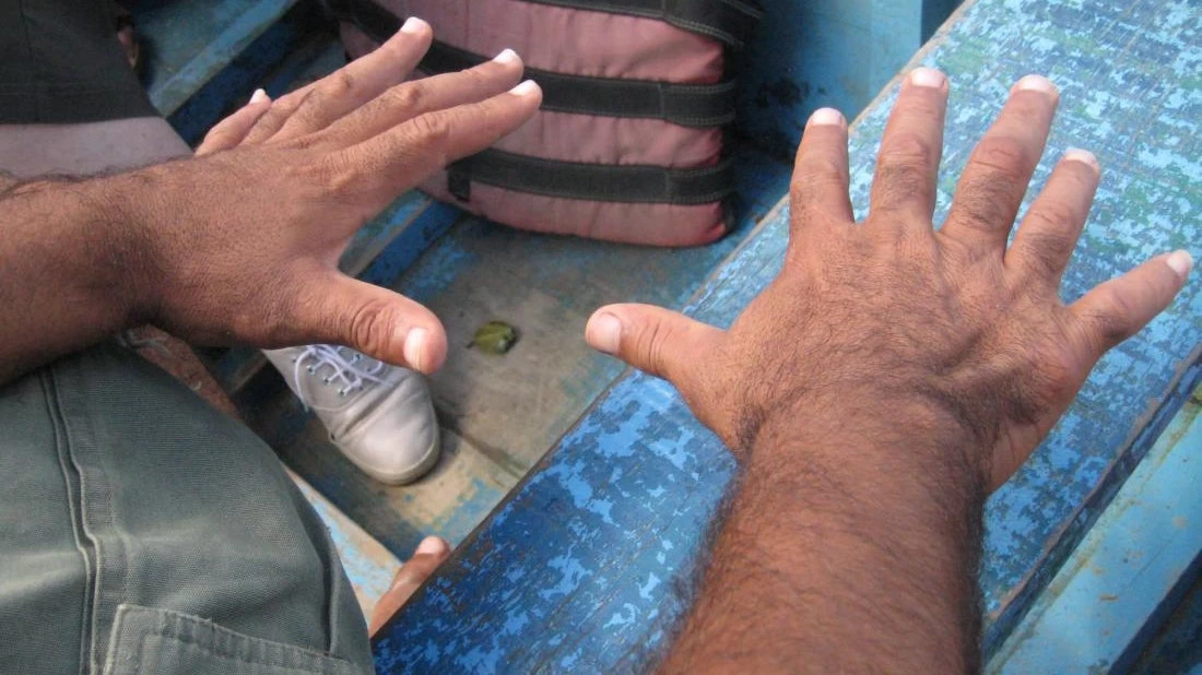 Πολυδακτυλία: Εντυπωσιακά ευρήματα για τον τρόπο λειτουργίας του εγκεφάλου